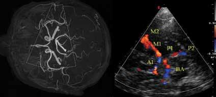 ACA tętnica mózgu przednia; PCA tętnica mózgu tylna; BA tętnica podstawna B koła Willisa w czasie rzeczywistym (ryc. 14).
