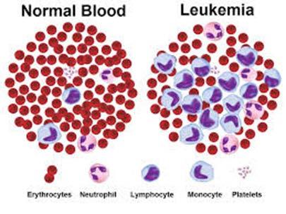 Przewlekła białaczka szpikowa (Chronic myeloid leukemia, CML) Definicja: to nowotwór mieloproliferacyjny, którego istotą jest klonalny rozwój nowotworowo zmnienionej wielopotencjalnej komórki