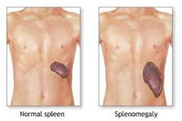 Splenomegalia w zespołach mieloproliferacyjnych Występuje z różnym nasileniem i częstością we wszystkich MPN Największą śledzionę obserwuje się w pierwotnej mielofibrozie (PMF) Najczęściej