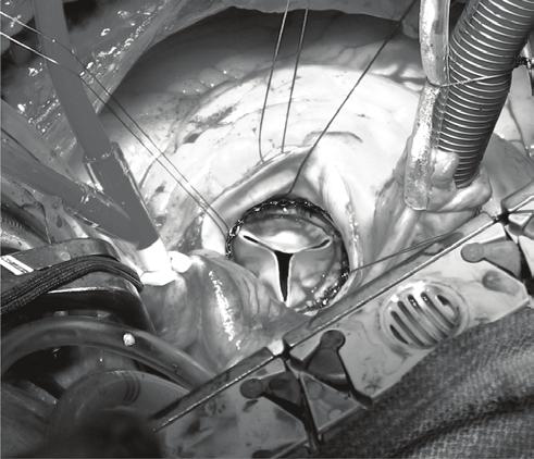 The three valve sizes 21, 23 and 25 are available for use.