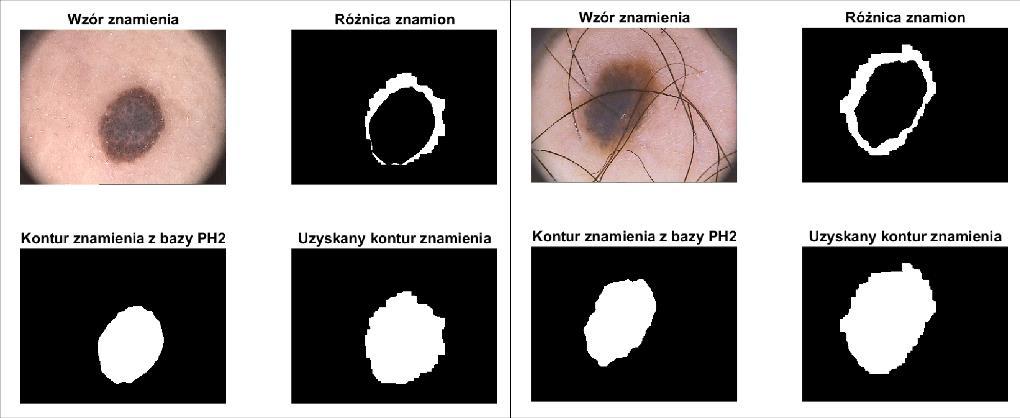 Study and Adjustment of Dermoscopic Image Processing Algorithms 43 Fig. 11. Result of border finding using MS method, test image 1 and 2 Rys. 11. Wynik znajdowania konturu metodą MS dla obrazów testowych 1 i 2 Fig.
