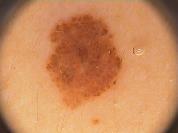 Study and Adjustment of Dermoscopic Image Processing Algorithms 35 morphological operations [7].