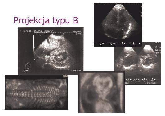 RODZAJE Prezentacja B (Brightness) polega na wizualizacji dwuwymiarowego przekroju, w której wartość chwilowa odbieranego sygnału moduluje jasność