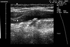 Grzegorz Madycki et al. Internal carotid artery kinking Polish Surgery 2004, 6, 4 ICA CCA ICA CCA ECA ECA Rycina 4.