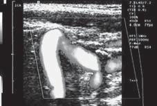 Acute kinking with coexisting atherosclerotic changes (control group treated with the eversion technique) Rycina 7.