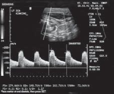 Duplex kinking (30 60 ) with significant increased flow (Vmax in I-st curve = 174 cm/s) phenomenon or is it secondary to a new-created and preserved ICA elongation.