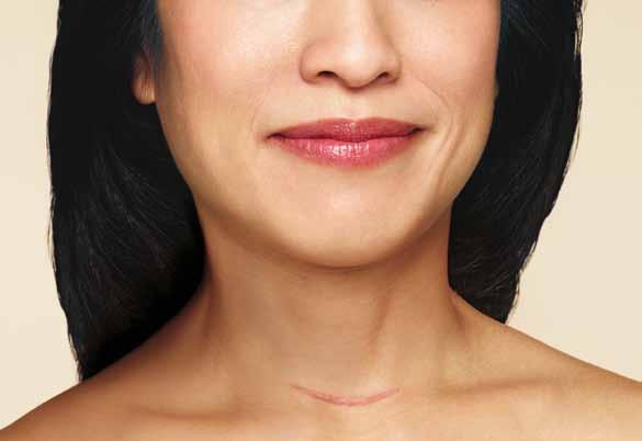 THYROGEN STABILNA JAKOSC ZYCIA Skuteczny wychwyt radiojodu w celu powodzenia ablacji i umozliwienia dalszego stosowania supresji hormonalnej u pacjentów 2,3 1 Telefony komórkowe Uprzejmie dziękujemy