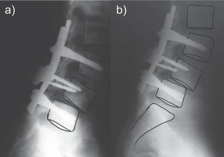 Valuation of development in surgical treatment of spondylolisthesis Initial unloading of intervertebral space relies on realization of surgical-mechanically actions.