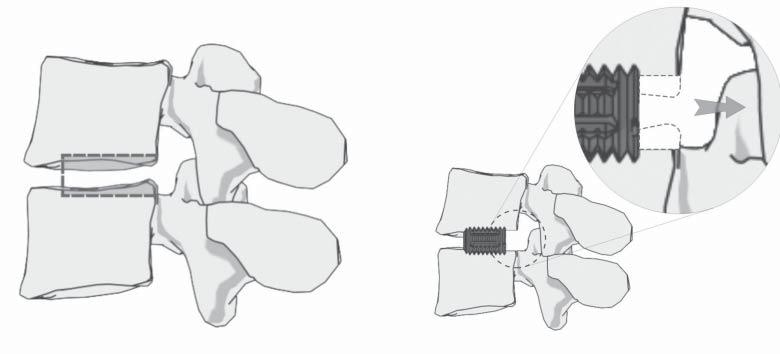 148 L. CIUPIK, B. BARAN, A. DOBKIEWICZ, D. ZARZYCKI Transpedicular stabilization was first supported by using bone grafts, which proved to be not sufficient protection.
