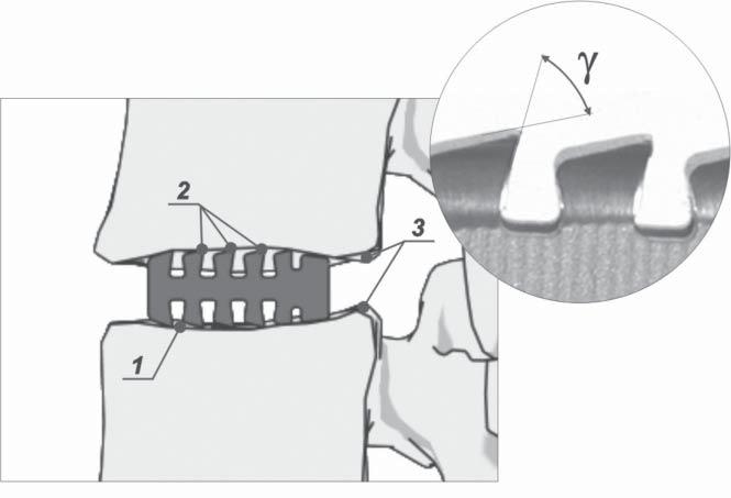Valuation of development in surgical treatment of spondylolisthesis DISCUSSION Application of various surgical methods requires individual evaluation of patient s state and considers patient s age,