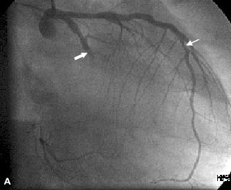 Angiografia wieńcowa W pierwszych godzinach zawału stwierdza się