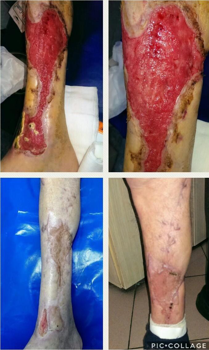 Leczenie - miejscowe: Łączny czas trwania 62 dni! 1. Opatrunek chirurgiczny i oczyszczenie 2. Tlenoterapia hiperbaryczna 10 sesji, od 15. do 25. dnia 3.