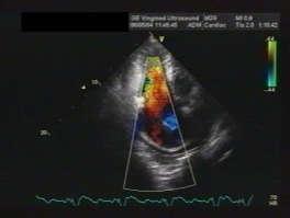 Różne typy obrazowania D, kolorowa mapa prędkośi (CFM) i sonogram Kolorowa mapa prędkośi wynik pomiaru prędkośi przepływu krwi w w poszzególnyh punktah obszaru obejmująym ałe nazynie bądź komory