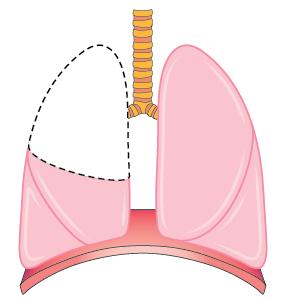 Treatments for lung cancer Treatments for lung cancer include: an operation (surgery) cancer drugs (chemotherapy or targeted therapy) radiotherapy.