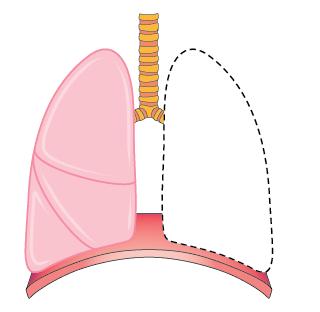 Surgery For some people, it may be possible to remove the cancer with an operation.