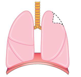 The three main operations to remove lung cancer are shown below.