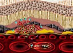 Pegaptanib pierwszy lek oparty o aptamer RNA Degenaracja plamki żółtej związanej z wiekiem (AMD)
