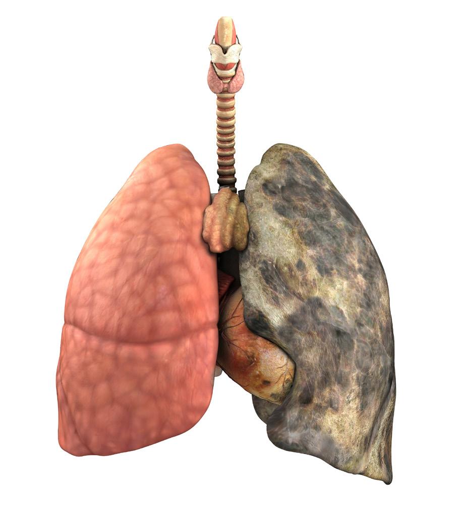 rak płuca Rak płuca Seryjny morderca Co to jest rak płuca? Rak płuca to najczęściej występujący w Polsce nowotwór złośliwy. Każdego roku na całym świecie umiera na niego ok.