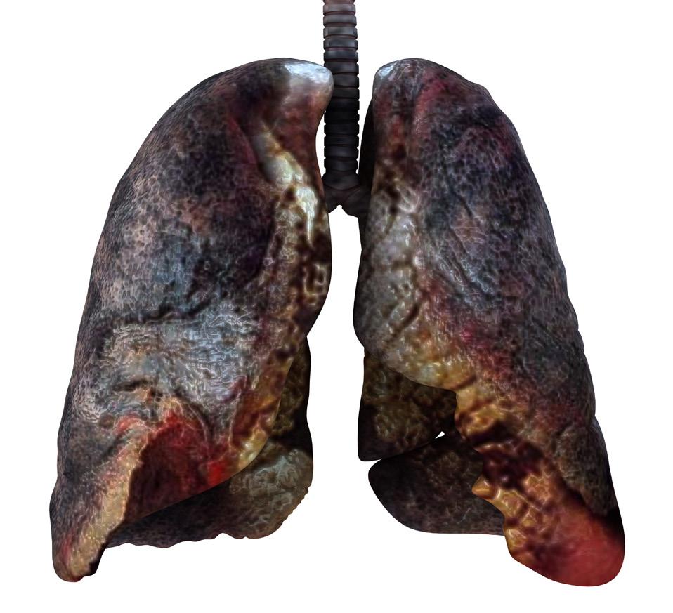 rak płuca Przy tak źle rokującym nowotworze złośliwym jak rak płuca wielką nadzieję stanowią badana kliniczne.