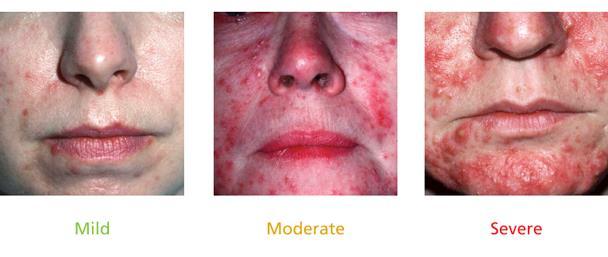 ROSACEA