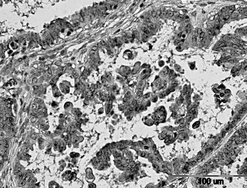 Ginekol Pol. 2010, 81, 176-182 Ekspresja markera limfangiogenezy neuropiliny-1.