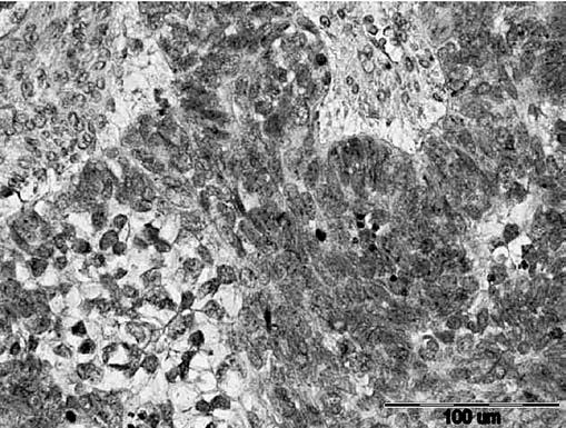 Bednarek W, et al. Rycina 2. Przykład słabo dodatniej ekspresji neuropiliny-1 w raku surowiczym jajnika (powiększenie 400x). Reakcje barwne widoczne przede wszystkim w cytoplazmie. Rycina 3.