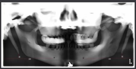 4. Head positioned with the chin too much downwards. Ustawienie modelu czaszki z nadmiernym pochyleniem do dołu. Fig. 5.
