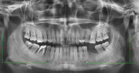 Diagnostic difficulties of the styloid process on panoramic radiographs J Stoma 2018; 71, 2 Fig. 6a. Panoramic radiograph taken for planning implant placement.