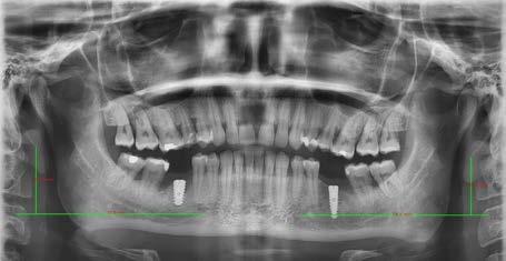 The image of the styloid processes is different on both X-rays due to different positions of the head.