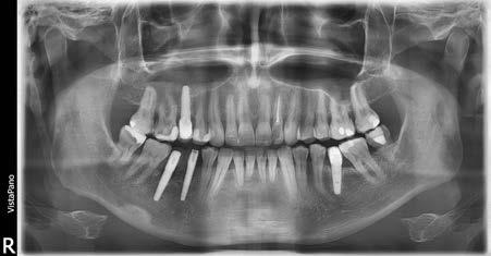 J Stoma 2018; 71, 2 Różyło K., Różyło-Kalinowska I., Piskórz M., Denkiewicz K., Szkutnik J. Fig. 7. Type I (uninterrupted) elongated styloid process above 30 mm on the right side.