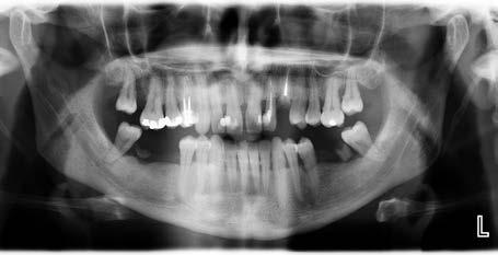 Diagnostic difficulties of the styloid process on panoramic radiographs J Stoma 2018; 71, 2 Fig. 13. Type A the apex of styloid process is visible above the level of mental foramen.