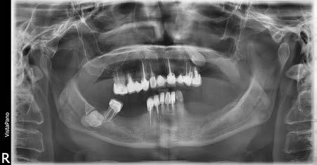 Type B the apex of styloid process is projected between the mental foramen level and the angle of the mandible.