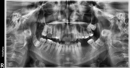 Typ C wierzchołek wyrostka rylcowatego rzutuje się poniżej kąta żuchwy. distance was 41.4 mm on the right and 39.4 mm on the left, while on post-implantation radiograph it equalled 27.