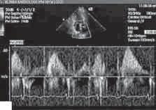 Zarejestrowany dopplerowską metodą fali pulsacyjnej laminarny przepływ przez otwór w błonie o prędkości maksymalnej 0,65 m/s Figure 1 A. Transthoracal echocardiogram, apical two-chamber view.