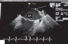 Recorded with pulsed Doppler laminar flow (peak velocity 0.65 m/s) through the membrane 2 A 2 B Rycina 2 A. Echokardiogram przezprzełykowy, projekcja dwujamowa.