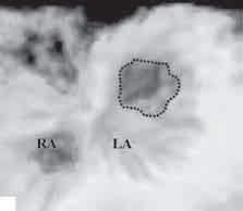 Obrysowany kropkami otwór w błonie łączący dwie jamy lewego przedsionka. Zmierzona powierzchnia otworu 5,4 cm 2 Figure 2 A. Transesophageal echocardiogram, 2-chamber view.