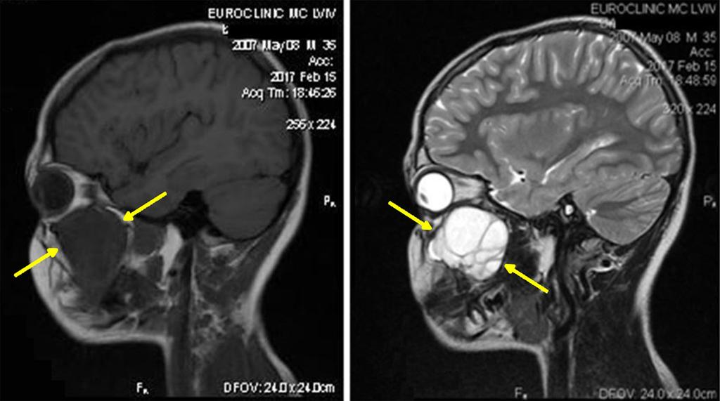 130 Otorynolaryngologia 2018, 17(3): 128-134 uwypuklającą się w stronę jamy nosa oraz unoszącą dolną ścianę oczodołu.