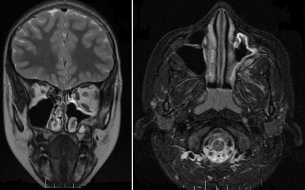 Otorynolaryngologia 2018, 17(3): 128-134 132 W chwili obecnej u pacjenta nie ma żadnych niepożądanych dolegliwości.