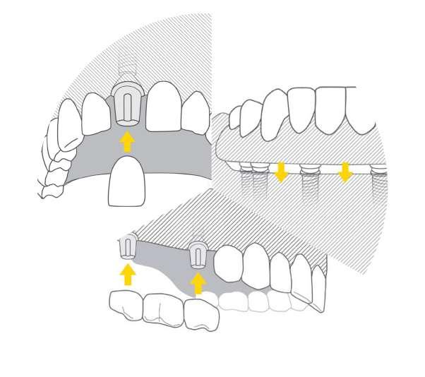 RODZAJE UZUPEŁNIEŃ PROTETYCZNYCH NA IMPLANTACH Wszczepienie implantów dentystycznych to doskonałe rozwiązanie dla Pacjentów w każdym wieku, którzy zmagają się z ubytkami w uzębieniu.