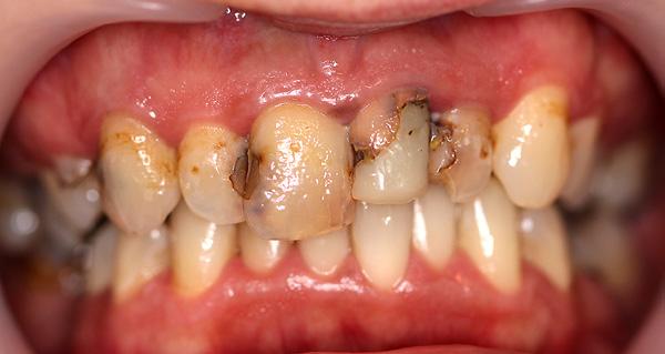 Bardzo nam zależało, aby ząb pozostał w jamie ustnej jak najdłużej, odraczając implantację. Usunięto wkład standardowy, oszczędzając jak najwięcej własnych tkanek zęba.