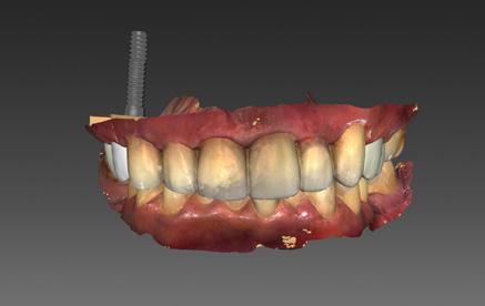 c a d /c a m Fot. 11. Skan oszlifowanych zębów przedtrzonowych i bazy tytanowej T-Base Fot. 12-14.