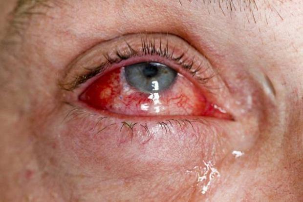 Zapalna oftalmopatia
