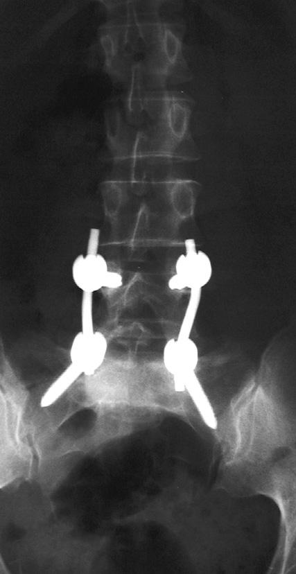 biodrowego. W obydwu przypadkach spondylodezê dokonano w drugim seansie operacyjnym.
