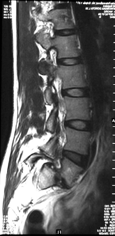 W przypadku u ycia klatek tytanowych kryteria zrostu zgodne harvested from the ilium. Both fusions were carried out in the second surgical time.
