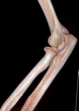 Ustalono, że w stawie skokowo-piętowym (pomarańczowa linia) było wystarczająco dużo kości, i pomyślnie zrekonstruowano kość piętową; radiografia 2D nie była w stanie