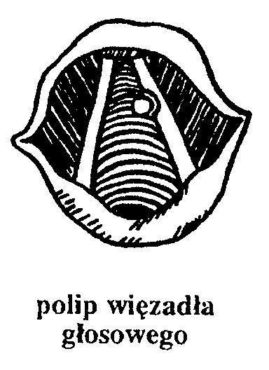 3.POLIPY To najczęściej spotykane łagodne guzki krtani. Mogą występować na jednym albo na obu fałdach głosowych.