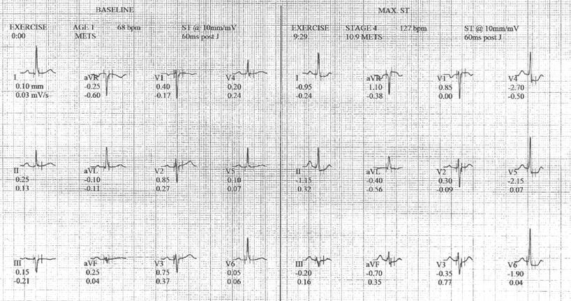 Choroby Serca i Naczyń 2013, tom 10, nr 1 Rycina 2. Elektrokardiograficzny test wysiłkowy (wg protokołu Bruce a): obniżenie odcinka ST w odprowadzeniach V4 V6, maksymalne 2,7 mm, w 10.