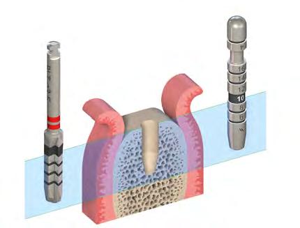 Krok 4 Poszerzenie łoża implantu do 3.5 mm 5.