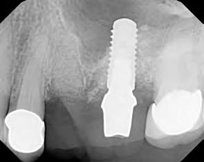 Cztery główne zalety nowego implantu Straumann Bone Level Stożkowy 1.