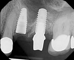 al., 1977; Meredith, 1998). Wysoki poziom stabilizacji pierwotnej zapobiega mikroruchom implantu i gwarantuje jego sztywność.